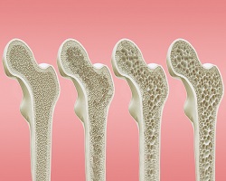 Fotografija uz vijest: Svetski dan borbe protiv osteoporoze: Prevencija ključna za zdravlje kostiju